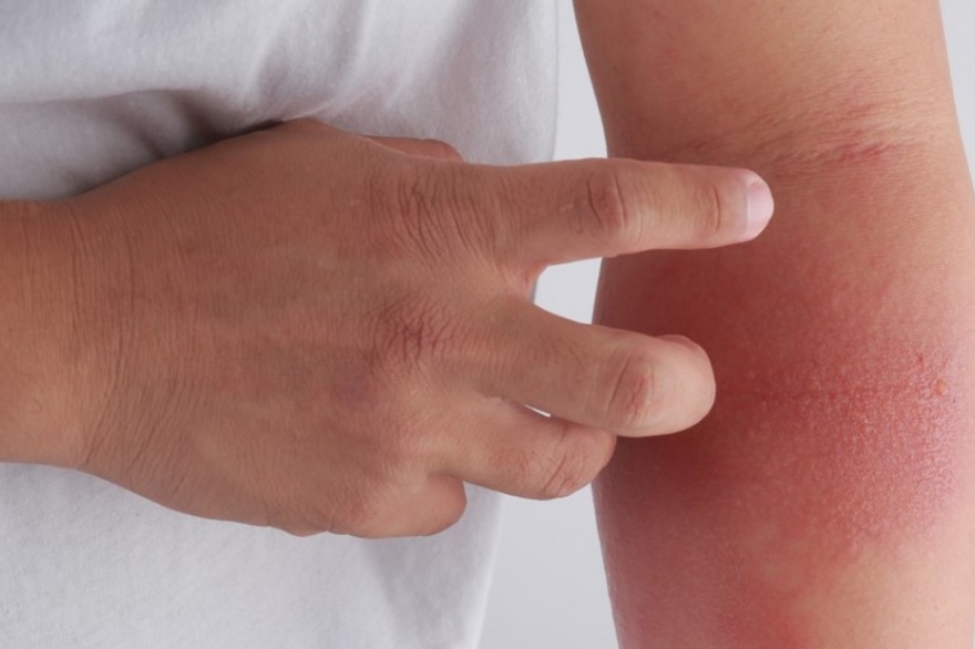El frío aumenta los brotes y agudiza los síntomas de irritación.