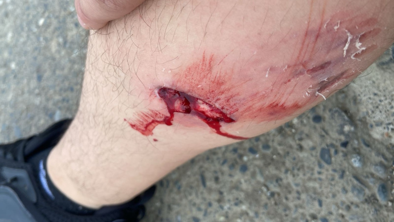 Grave ataque de un pitbull a un joven en Río Grande: denunciaron a los dueños