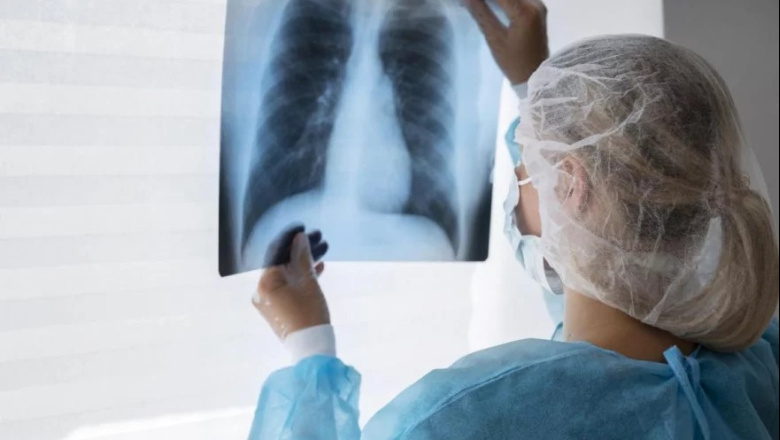 Preocupa el aumento de casos de tuberculosis en Argentina: ya superaron los 17.000 de 2025