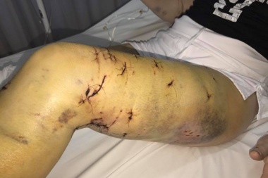 Fuertes imágenes: Así quedó la mujer atacada por una jauría de perros en Ushuaia