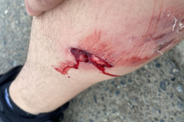 Grave ataque de un pitbull a un joven en Río Grande: denunciaron a los dueños